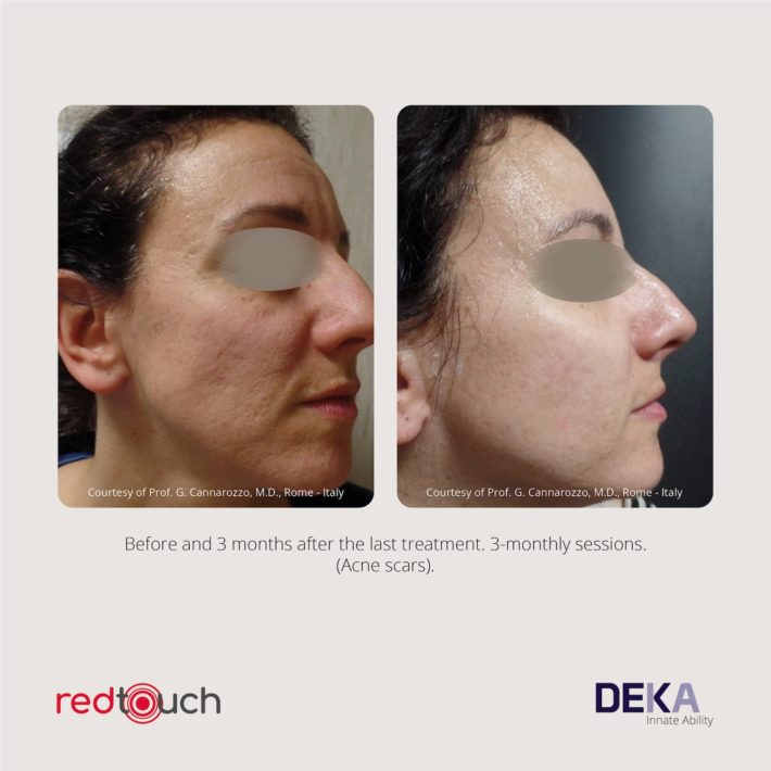 Clinical Results RedTouch ING Rev 1.010