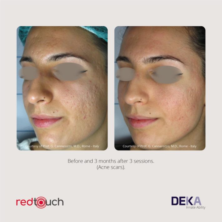 Clinical Results RedTouch ING Rev 1.02