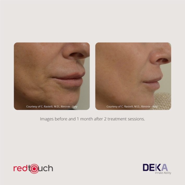 Clinical Results RedTouch ING Rev 1.028