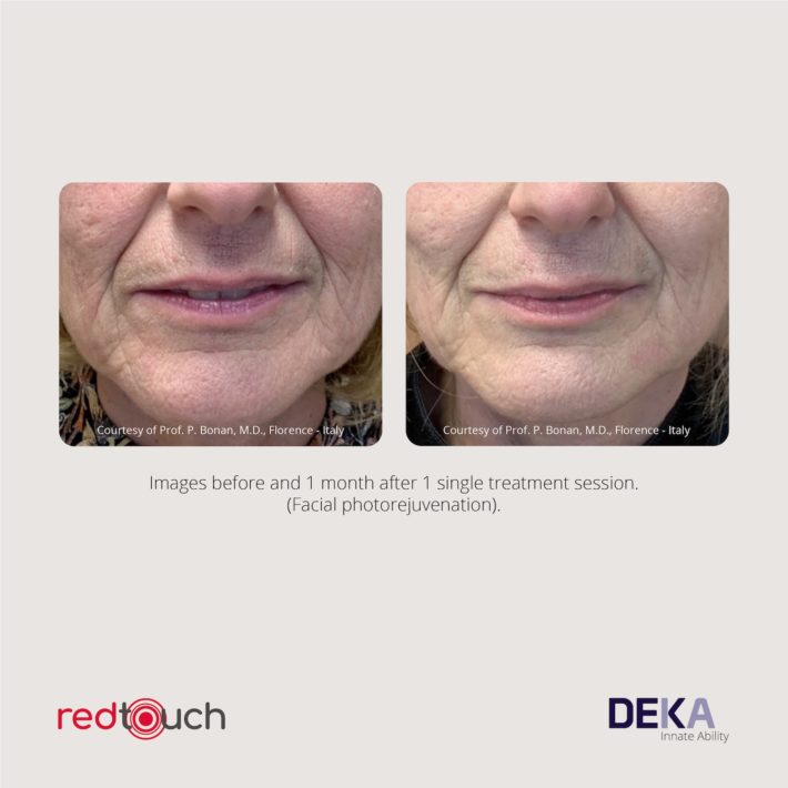 Clinical Results RedTouch ING Rev 1.050